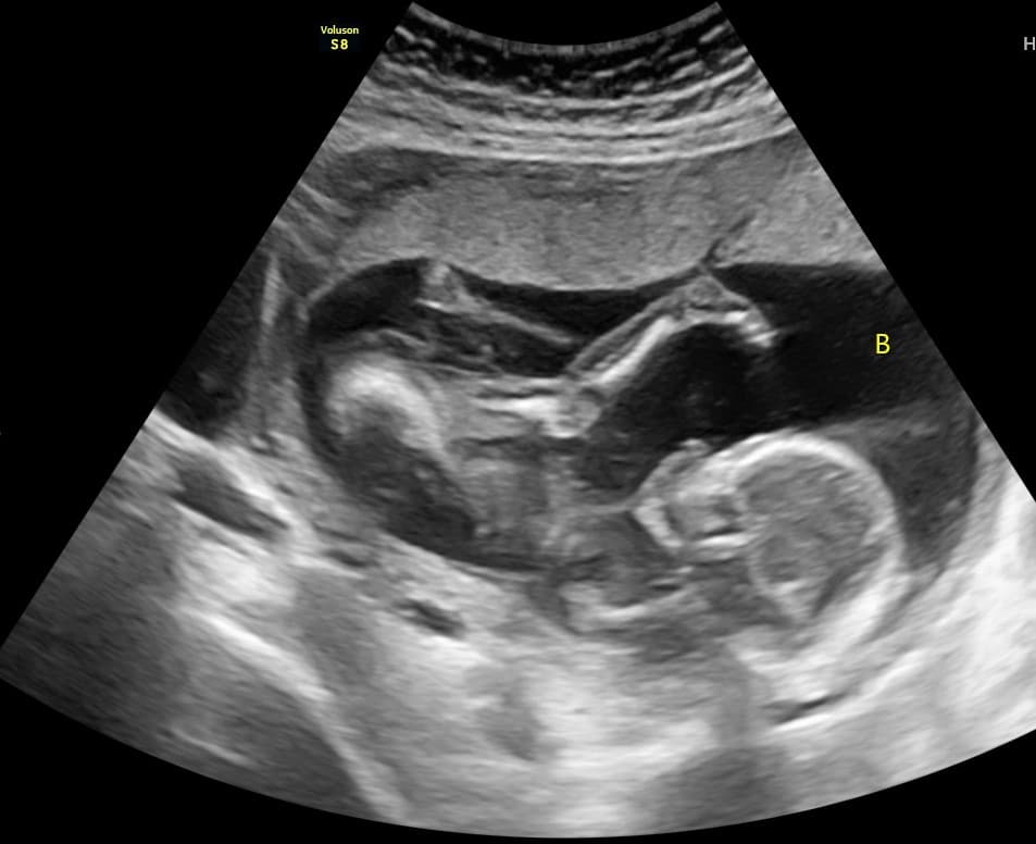 2D sónar/kynjasónar